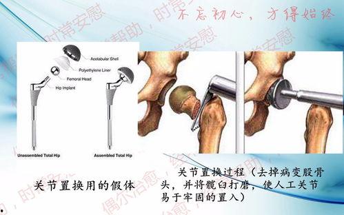 关节置换手术视频,从术前准备到术后康复